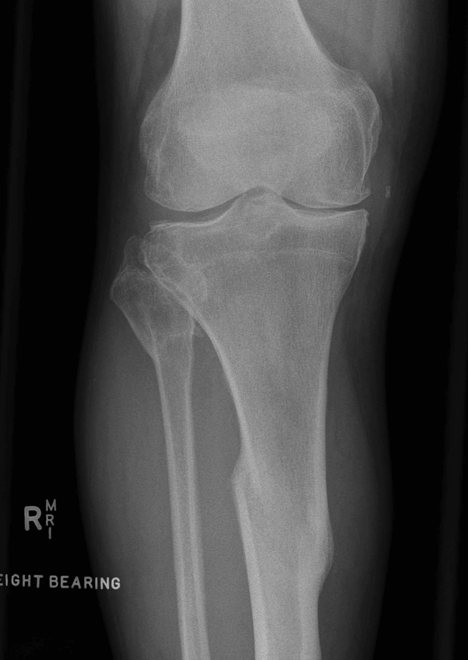 TKR Tibial Deformity